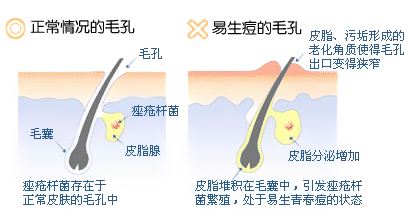 痘痘形成的主要原因  中藥問症