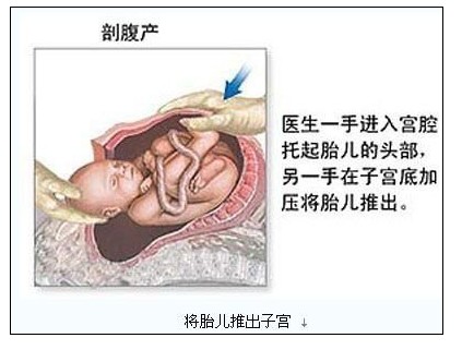 性剖腹产全过程  媽媽 + 寶寶
