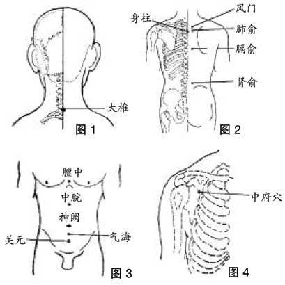 刮痧的17個禁忌  中藥問症