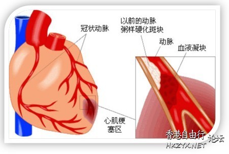 怎樣預防冠心病?  内科防治室