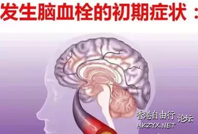 腦血栓前兆當天6個暗號  内科防治室