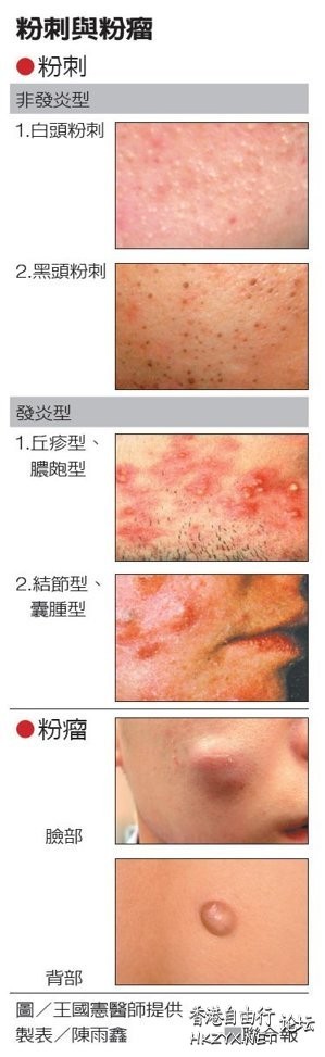 粉瘤、粉刺，有什麼不同？  美容護理