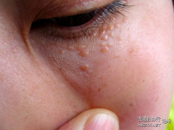 女人臉上脂肪粒去除  美容護理