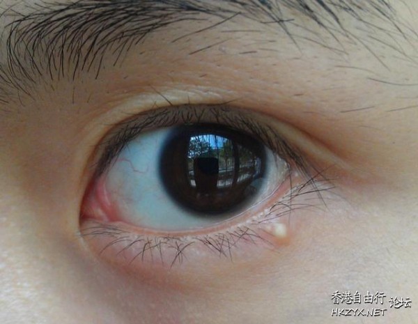 女人臉上脂肪粒去除  美容護理