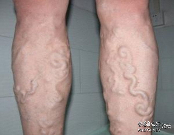青筋越凸起就越嚴重  中藥問症