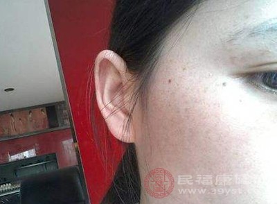 什么叫做激素脸  美容護理